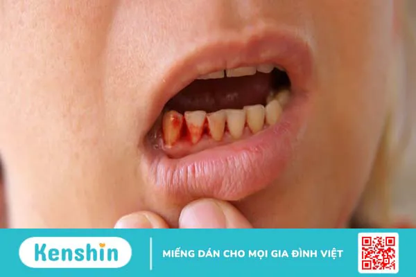 Sốt xuất huyết nên ăn gì, kiêng gì để nhanh khỏi và lưu ý khi điều trị