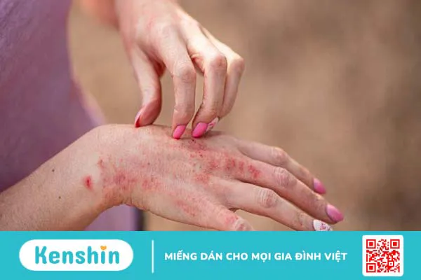 Sử dụng sữa dưỡng thể bị ngứa và cách khắc phục khi bị dị ứng mỹ phẩm