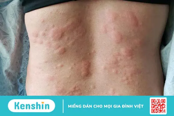 Sử dụng sữa dưỡng thể bị ngứa và cách khắc phục khi bị dị ứng mỹ phẩm