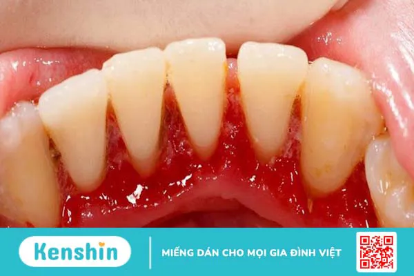 Sưng nướu răng là gì? Có nguy hiểm không? Nguyên nhân và cách điều trị