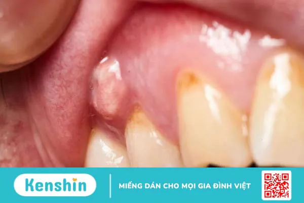 Sưng nướu răng là gì? Có nguy hiểm không? Nguyên nhân và cách điều trị