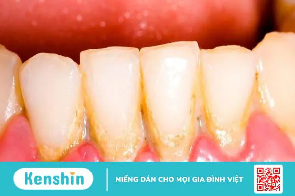 Sưng nướu răng là gì? Có nguy hiểm không? Nguyên nhân và cách điều trị