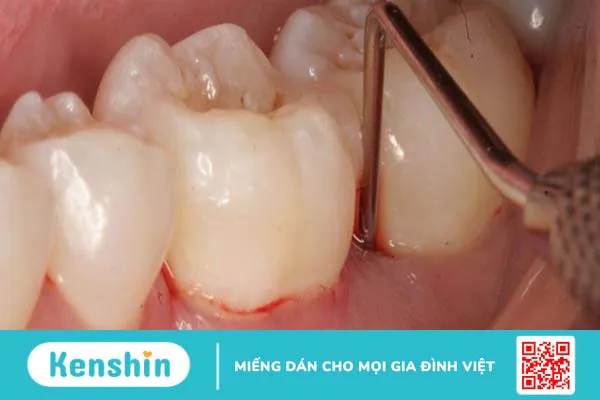 Sưng nướu răng là gì? Có nguy hiểm không? Nguyên nhân và cách điều trị