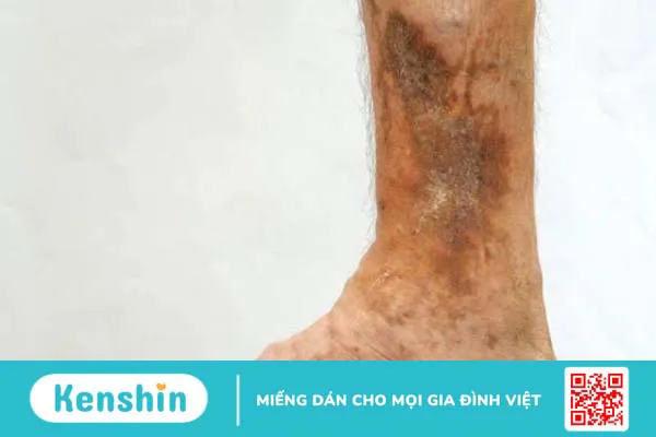 Suy giãn tĩnh mạch có nguy hiểm không?