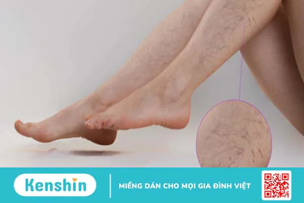 Suy giãn tĩnh mạch có nguy hiểm không?