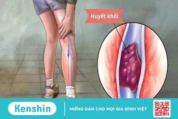 Suy giãn tĩnh mạch có nguy hiểm không?