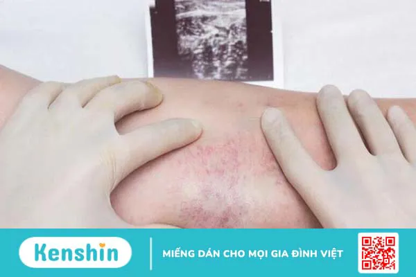 Suy giãn tĩnh mạch có nguy hiểm không?