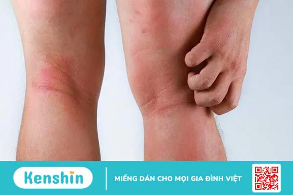 Suy giãn tĩnh mạch có nguy hiểm không?