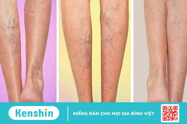 Suy giãn tĩnh mạch có nguy hiểm không?