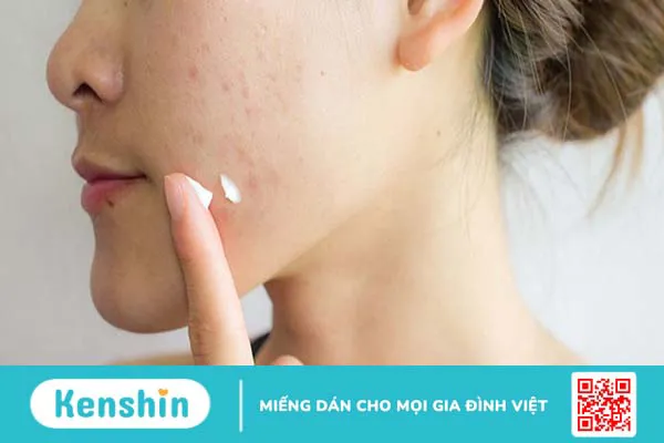 Tác dụng của vitamin A đối với da và trong điều trị mụn trứng cá