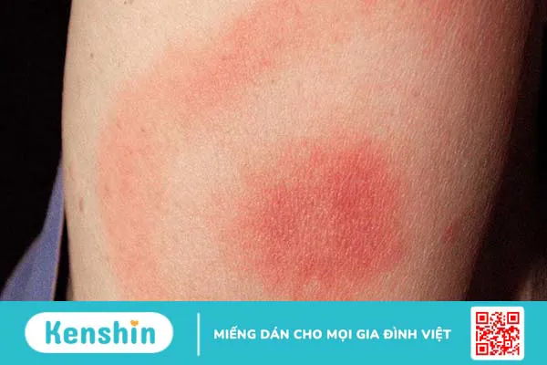 Tác dụng phụ thường gặp sau khi tiêm vắc-xin Covid-19