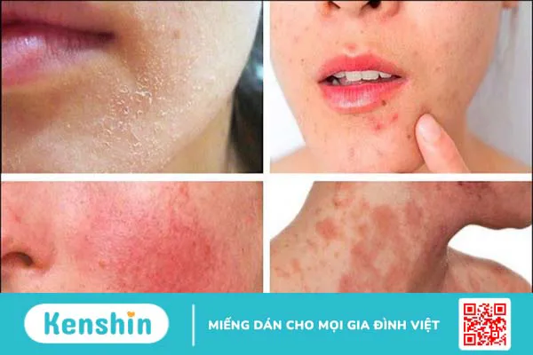 Tác hại của nước mưa đối với làn da và cách chăm sóc da sau khi đi mưa