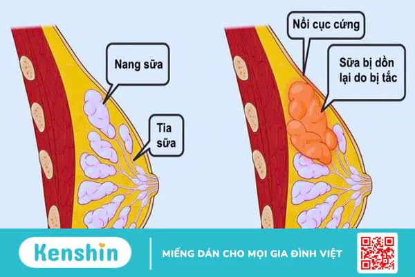 Tắc tia sữa phải làm sao? 16 cách chữa tắc tia sữa hiệu quả tại nhà