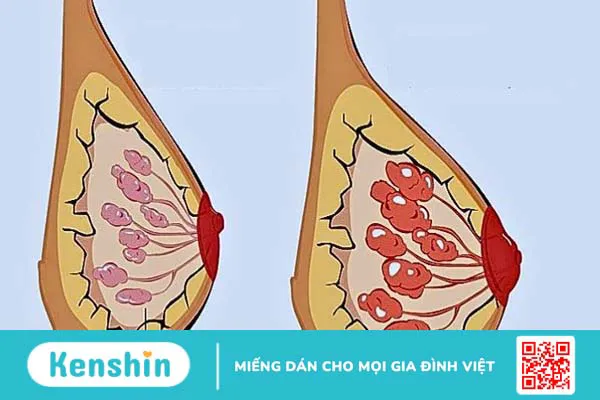 Tắc tia sữa phải làm sao? 16 cách chữa tắc tia sữa hiệu quả tại nhà