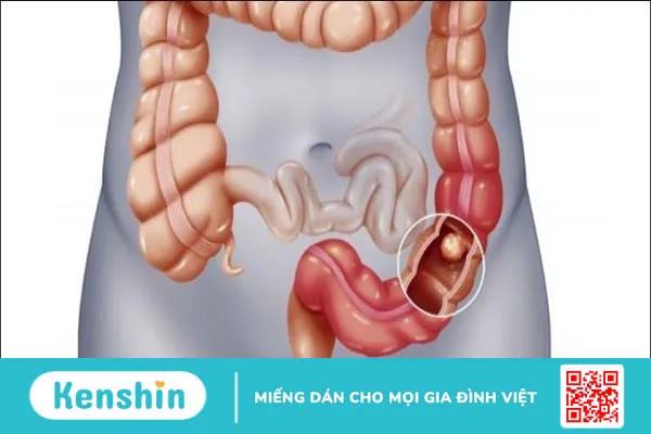 Táo bón nên ăn gì và kiêng gì? Lưu ý cho người táo bón