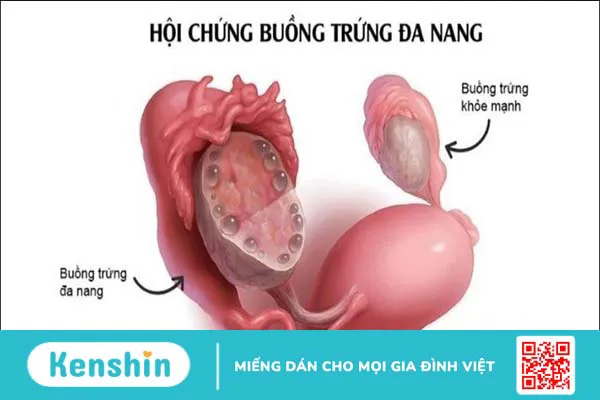 Thâm hụt calo là gì? Cách ăn thâm hụt calo để giảm cân và các lưu ý