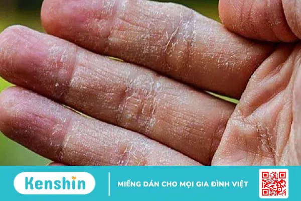 Thiếu Iodine (I ốt) nguyên nhân, triệu chứng và biện pháp phòng chống