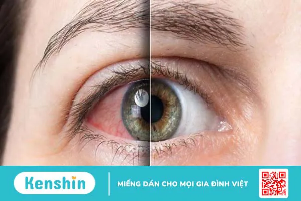 Thiếu vitamin A gây ra bệnh gì? Cách phòng, chống vitamin A