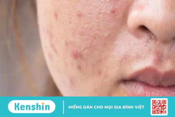 Thiếu vitamin A gây ra bệnh gì? Cách phòng, chống vitamin A