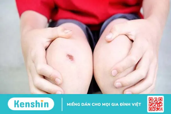 Thiếu vitamin A gây ra bệnh gì? Cách phòng, chống vitamin A