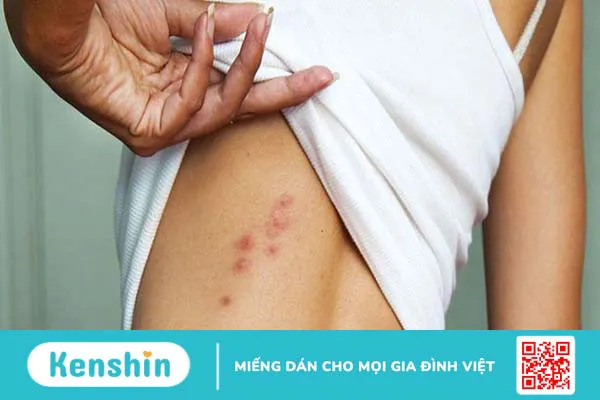 Thiếu vitamin A gây ra bệnh gì? Cách phòng, chống vitamin A