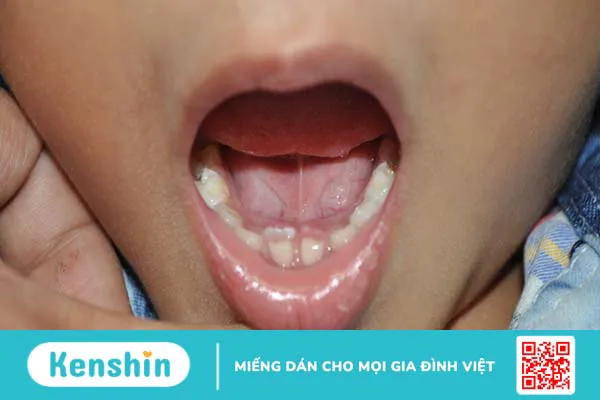 Thời điểm nên niềng răng và các phương pháp niềng răng hiện nay