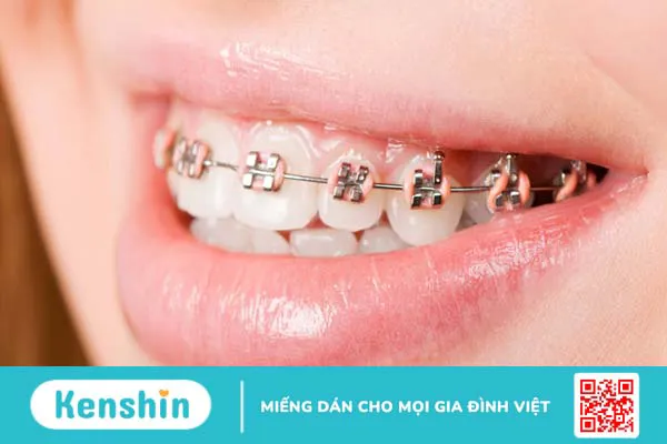 Thời điểm nên niềng răng và các phương pháp niềng răng hiện nay