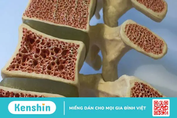 Thừa vitamin A gây ra bệnh gì? Dấu hiệu bạn cần nên biết