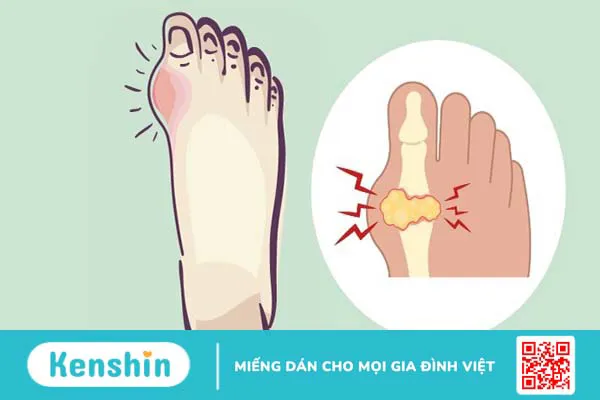 Thừa vitamin C gây bệnh gì? 6 dấu hiệu nhận biết khi thừa vitamin C