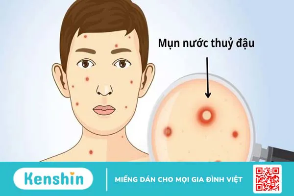 Thủy đậu có để lại sẹo không? 21 cách trị sẹo thủy đậu hiệu quả