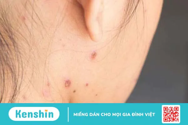 Thủy đậu có để lại sẹo không? 21 cách trị sẹo thủy đậu hiệu quả