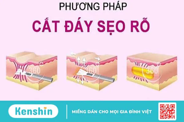 Thủy đậu có để lại sẹo không? 21 cách trị sẹo thủy đậu hiệu quả