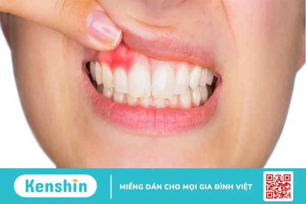 Tinh dầu đinh hương có thể giảm đau răng không?