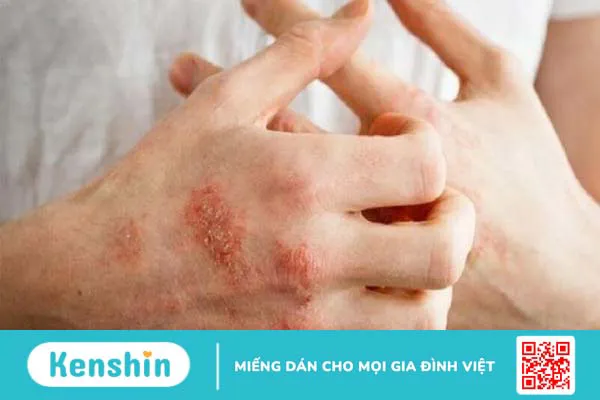 Tinh dầu hoa anh thảo là gì? 10 tác dụng, cách dùng và lưu ý khi sử dụng