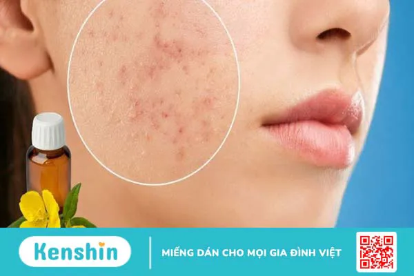 Tinh dầu hoa anh thảo là gì? 10 tác dụng, cách dùng và lưu ý khi sử dụng