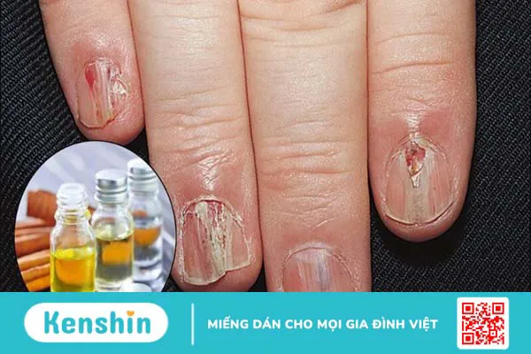 Tinh dầu quế có tác dụng gì? 14 tác dụng và lưu ý khi sử dụng