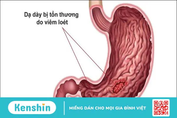 Tinh dầu quế có tác dụng gì? 14 tác dụng và lưu ý khi sử dụng