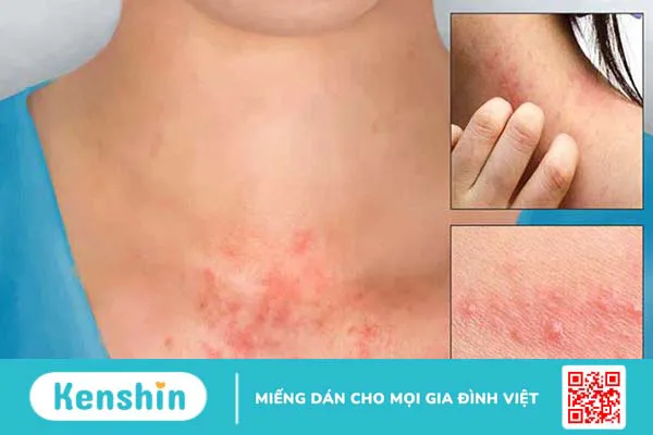 Tinh dầu tràm trà có tác dụng gì? 11 lợi ích tuyệt vời bạn nên biết