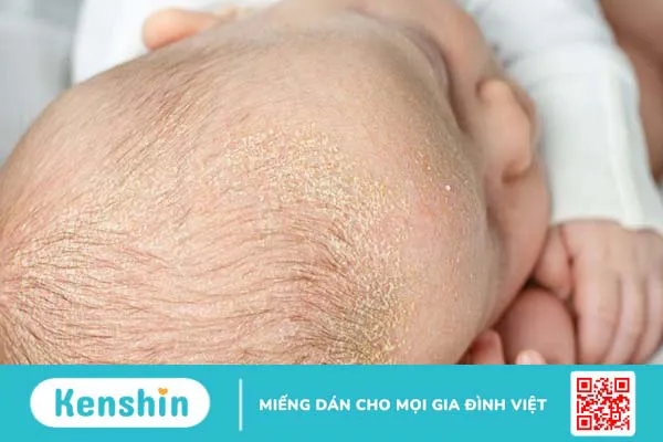 Tinh dầu tràm trà có tác dụng gì? 11 lợi ích tuyệt vời bạn nên biết