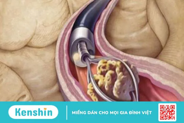 Tinh thể canxi oxalat: Nguyên nhân, triệu chứng, điều trị và cách phòng ngừa