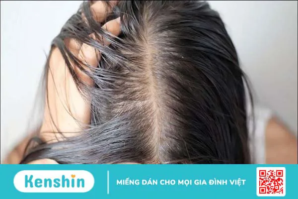 Top 16 loại dầu gội trị gàu, nấm da đầu hiệu quả, nhiều người tin dùng