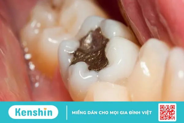 Trám răng là gì? Quy trình trám răng gồm các bước nào?