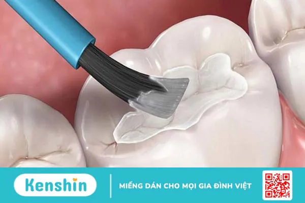 Trám răng là gì? Quy trình trám răng gồm các bước nào?