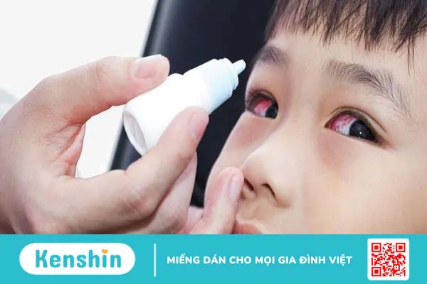 Trẻ bị đau mắt đỏ: Một số lưu ý cha mẹ cần quan tâm!