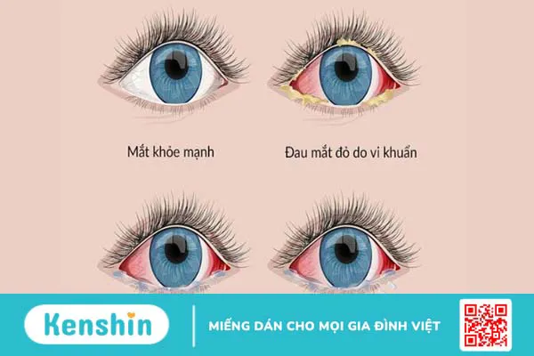 Trẻ bị đau mắt đỏ: Một số lưu ý cha mẹ cần quan tâm!