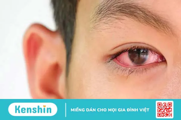 Trẻ bị đau mắt đỏ: Một số lưu ý cha mẹ cần quan tâm!