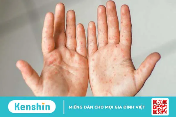 Trẻ bị tay chân miệng nên ăn gì và kiêng ăn gì để nhanh khỏi?