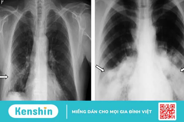 Trẻ em mắc Covid-19 có di chứng không?