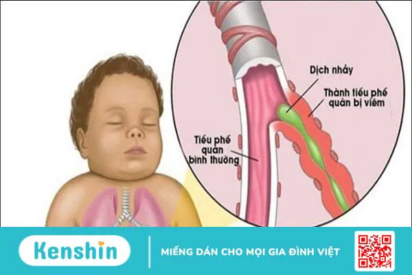 Trẻ sốt siêu vi mấy ngày hết? Cách chăm sóc cho bé mau hết bệnh