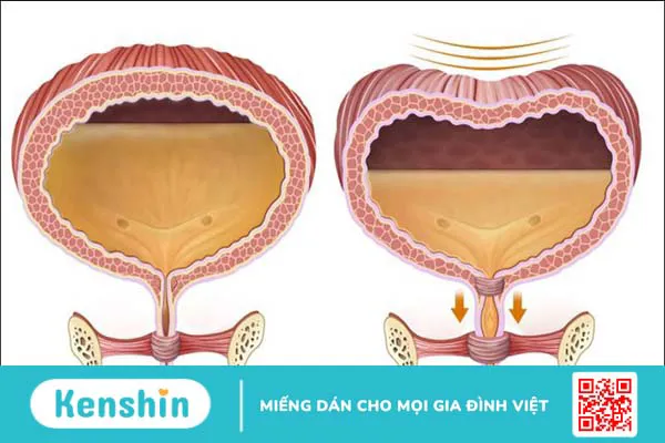 Triệu chứng bàng quang thần kinh bạn không nên bỏ qua